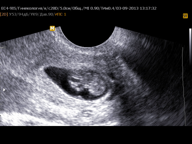 9 мм беременность. Плодное яйцо эмбрион 4 мм. Плодное яйцо 8 недель УЗИ. Пя 9.9 мм желточный мешок 1.1 мм анэмбриония. Плодное яйцо 7 мм желточный мешок 6 мм.