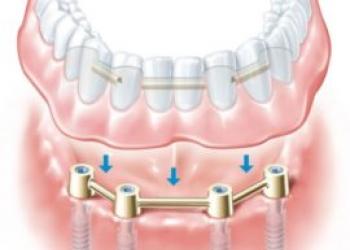 부분 가철성 의치, 치아 구조 부분 가철성 의치의 모습