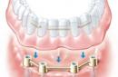 Хэсэгчилсэн авагддаг хиймэл шүд, шүдний бүтэц Хэсэгчилсэн авагддаг хиймэл шүд ямар харагддаг вэ